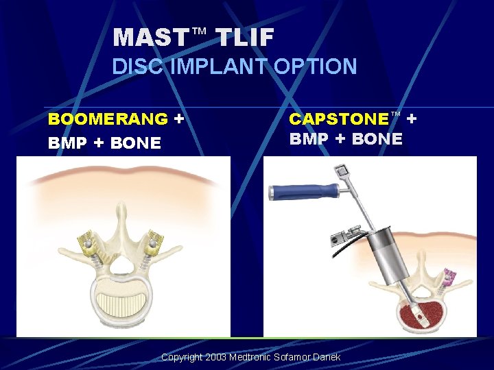 MAST™ TLIF DISC IMPLANT OPTION BOOMERANG + BMP + BONE CAPSTONE™ + BMP + MAST™ TLIF DISC IMPLANT OPTION BOOMERANG + BMP + BONE CAPSTONE™ + BMP +