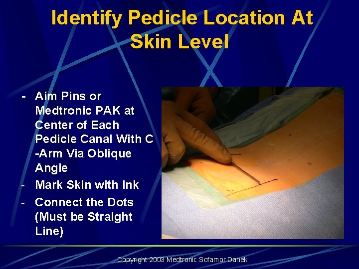Identify Pedicle Location At Skin Level - Aim Pins or Medtronic PAK at Identify Pedicle Location At Skin Level - Aim Pins or Medtronic PAK at