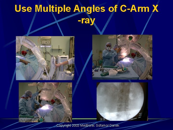 Use Multiple Angles of C-Arm X -ray Copyright 2003 Medtronic Sofamor Danek Use Multiple Angles of C-Arm X -ray Copyright 2003 Medtronic Sofamor Danek