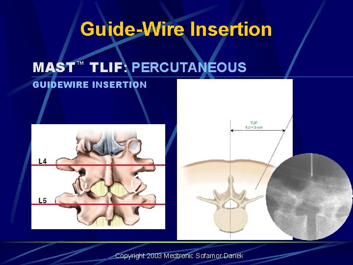 Guide-Wire Insertion MAST™ TLIF: PERCUTANEOUS GUIDEWIRE INSERTION Copyright 2003 Medtronic Sofamor Danek Guide-Wire Insertion MAST™ TLIF: PERCUTANEOUS GUIDEWIRE INSERTION Copyright 2003 Medtronic Sofamor Danek