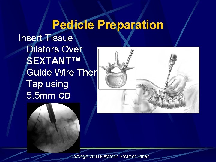 Pedicle Preparation Insert Tissue Dilators Over SEXTANT™ Guide Wire Then Tap using 5. 5 Pedicle Preparation Insert Tissue Dilators Over SEXTANT™ Guide Wire Then Tap using 5. 5