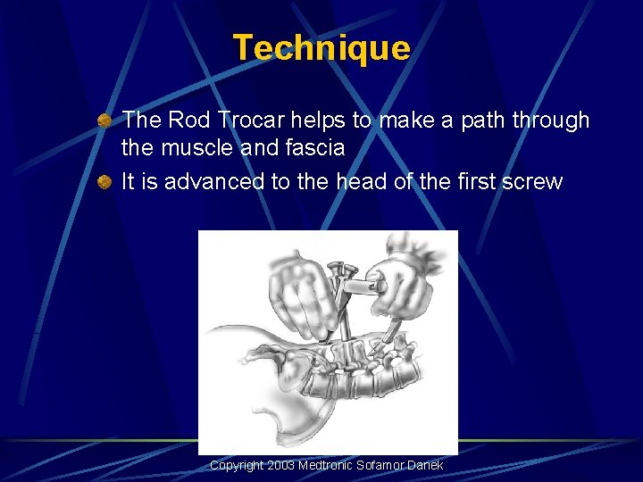 Technique The Rod Trocar helps to make a path through the muscle and fascia Technique The Rod Trocar helps to make a path through the muscle and fascia