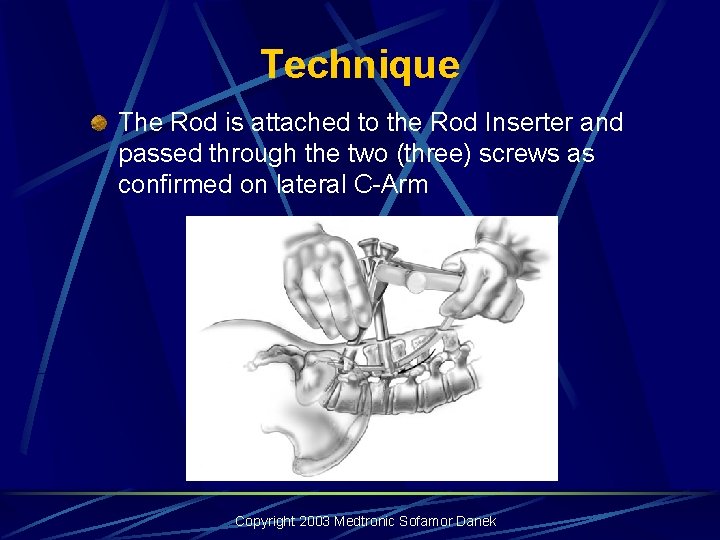 Technique The Rod is attached to the Rod Inserter and passed through the two Technique The Rod is attached to the Rod Inserter and passed through the two