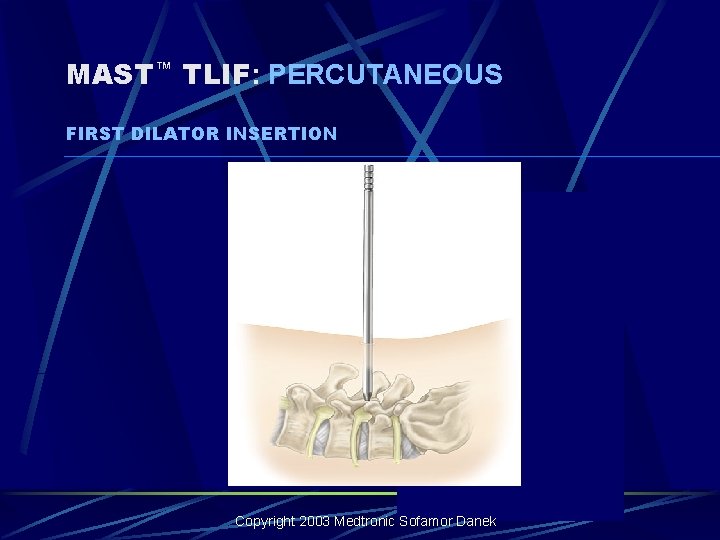 MAST™ TLIF: PERCUTANEOUS FIRST DILATOR INSERTION Copyright 2003 Medtronic Sofamor Danek MAST™ TLIF: PERCUTANEOUS FIRST DILATOR INSERTION Copyright 2003 Medtronic Sofamor Danek