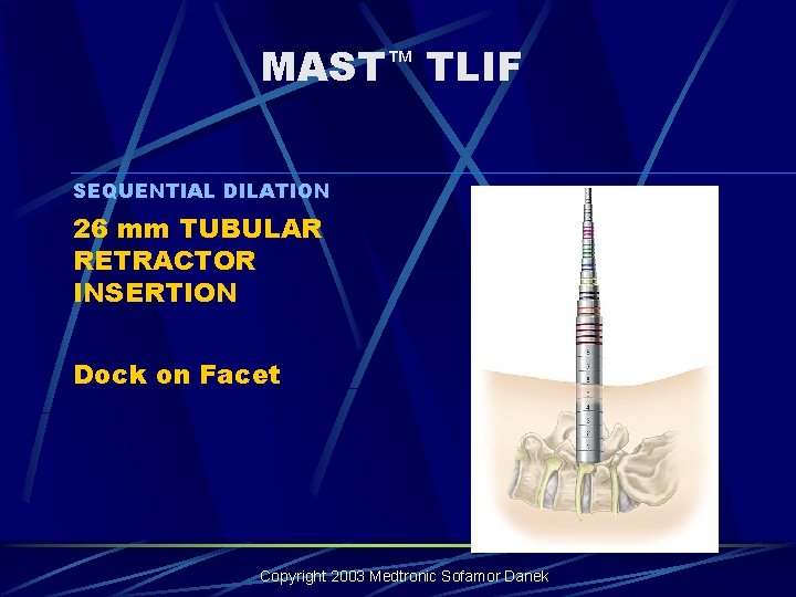 MAST™ TLIF SEQUENTIAL DILATION 26 mm TUBULAR RETRACTOR INSERTION Dock on Facet Copyright 2003 MAST™ TLIF SEQUENTIAL DILATION 26 mm TUBULAR RETRACTOR INSERTION Dock on Facet Copyright 2003