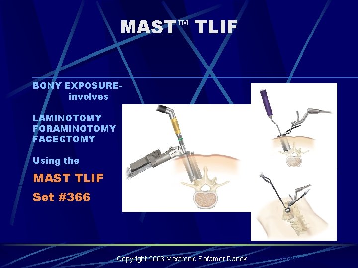 MAST™ TLIF BONY EXPOSUREinvolves LAMINOTOMY FORAMINOTOMY FACECTOMY Using the MAST TLIF Set #366 Incorporates MAST™ TLIF BONY EXPOSUREinvolves LAMINOTOMY FORAMINOTOMY FACECTOMY Using the MAST TLIF Set #366 Incorporates