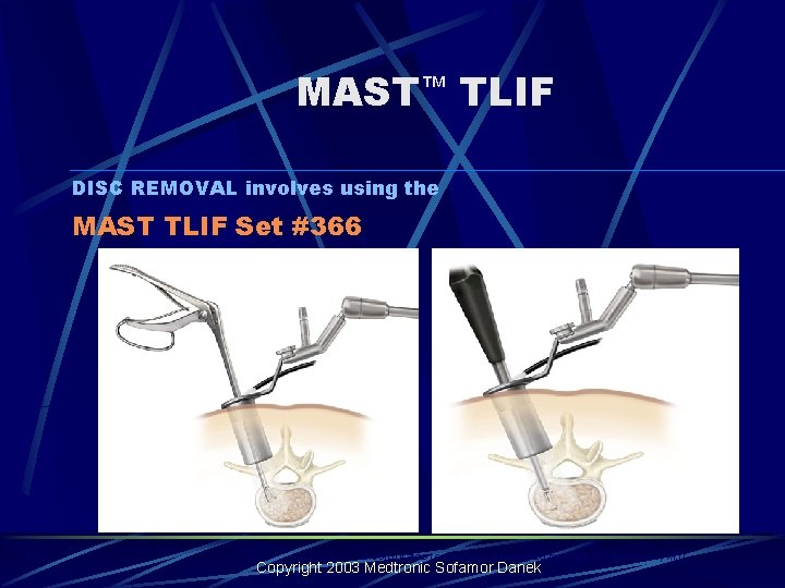 MAST™ TLIF DISC REMOVAL involves using the MAST TLIF Set #366 Incorporates technology developed MAST™ TLIF DISC REMOVAL involves using the MAST TLIF Set #366 Incorporates technology developed