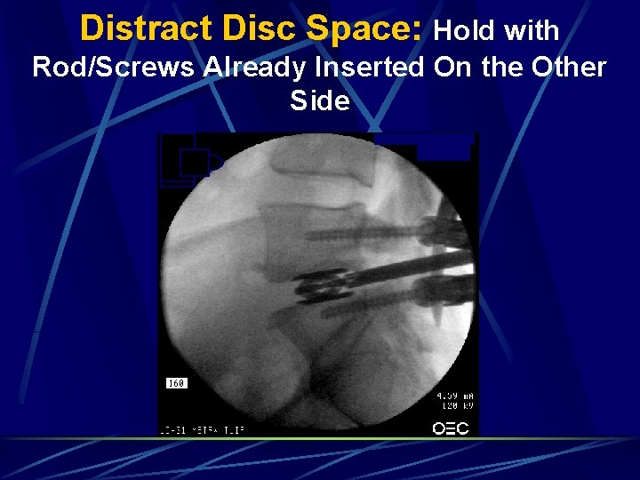 Distract Disc Space: Hold with Rod/Screws Already Inserted On the Other Side Distract Disc Space: Hold with Rod/Screws Already Inserted On the Other Side