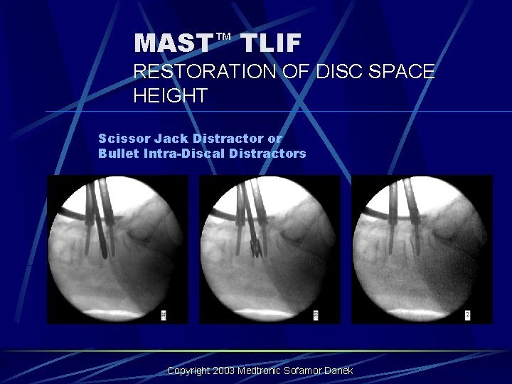 MAST™ TLIF RESTORATION OF DISC SPACE HEIGHT Scissor Jack Distractor or Bullet Intra-Discal Distractors MAST™ TLIF RESTORATION OF DISC SPACE HEIGHT Scissor Jack Distractor or Bullet Intra-Discal Distractors