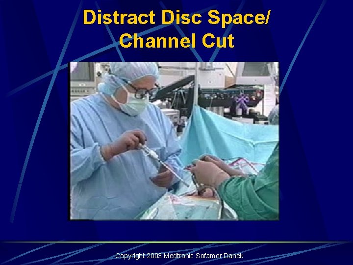 Distract Disc Space/ Channel Cut Copyright 2003 Medtronic Sofamor Danek Distract Disc Space/ Channel Cut Copyright 2003 Medtronic Sofamor Danek