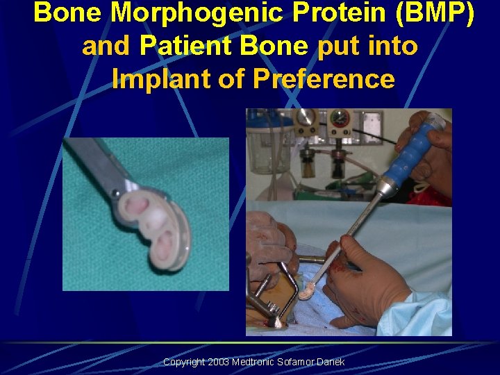 Bone Morphogenic Protein (BMP) and Patient Bone put into Implant of Preference Copyright Bone Morphogenic Protein (BMP) and Patient Bone put into Implant of Preference Copyright