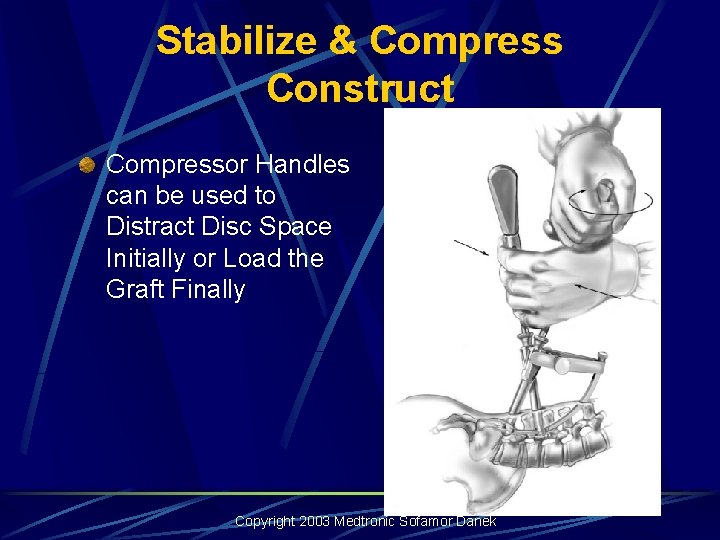 Stabilize & Compress Construct Compressor Handles can be used to Distract Disc Space Initially Stabilize & Compress Construct Compressor Handles can be used to Distract Disc Space Initially