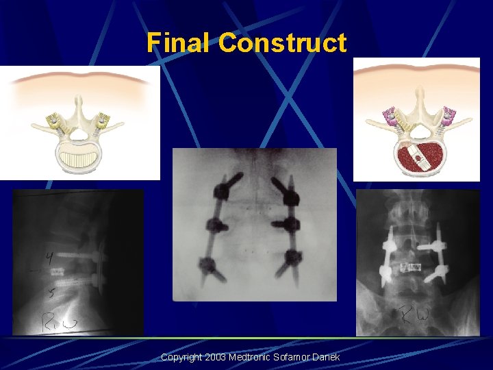 Final Construct Copyright 2003 Medtronic Sofamor Danek Final Construct Copyright 2003 Medtronic Sofamor Danek