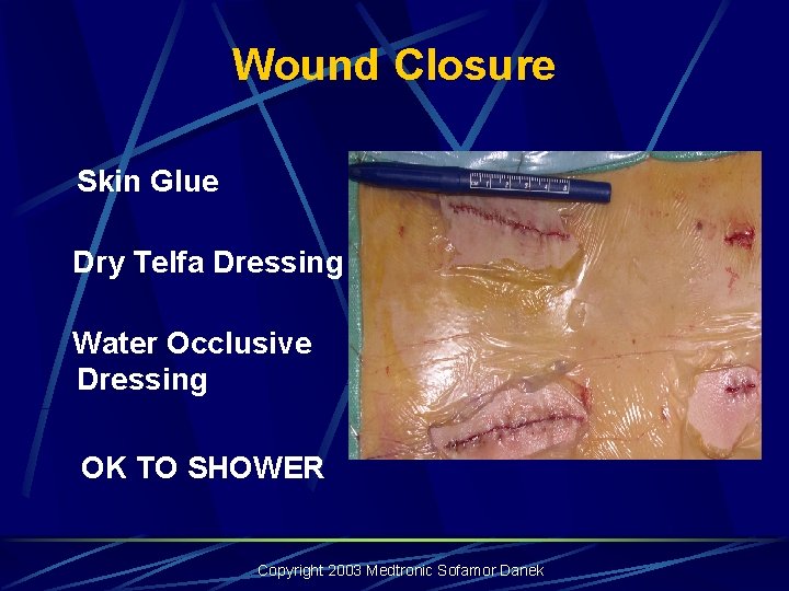 Wound Closure Skin Glue Dry Telfa Dressing Water Occlusive Dressing OK TO SHOWER Copyright Wound Closure Skin Glue Dry Telfa Dressing Water Occlusive Dressing OK TO SHOWER Copyright