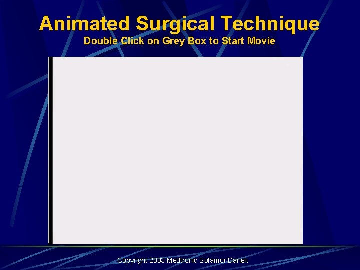Animated Surgical Technique Double Click on Grey Box to Start Movie Copyright 2003 Medtronic Animated Surgical Technique Double Click on Grey Box to Start Movie Copyright 2003 Medtronic