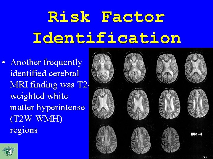 Risk Factor Identification • Another frequently identified cerebral MRI finding was T 2 weighted