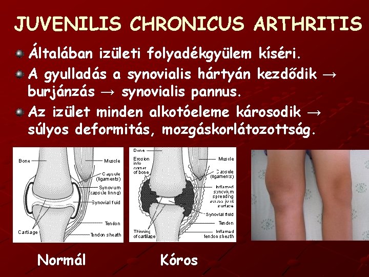 JUVENILIS CHRONICUS ARTHRITIS Általában izületi folyadékgyülem kíséri. A gyulladás a synovialis hártyán kezdődik →