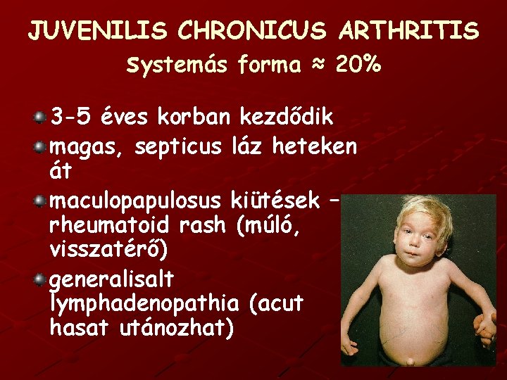 JUVENILIS CHRONICUS ARTHRITIS systemás forma ≈ 20% 3 -5 éves korban kezdődik magas, septicus