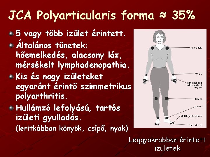 JCA Polyarticularis forma ≈ 35% 5 vagy több izület érintett. Általános tünetek: hőemelkedés, alacsony