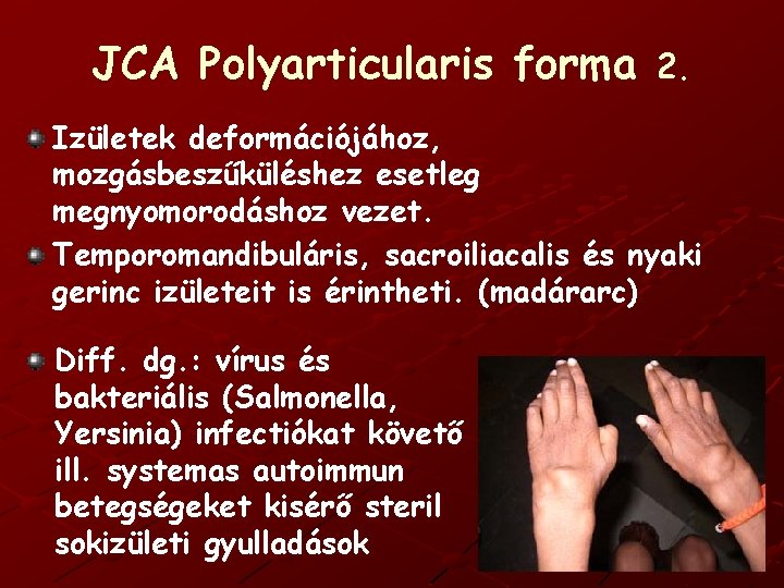 JCA Polyarticularis forma 2. Izületek deformációjához, mozgásbeszűküléshez esetleg megnyomorodáshoz vezet. Temporomandibuláris, sacroiliacalis és nyaki