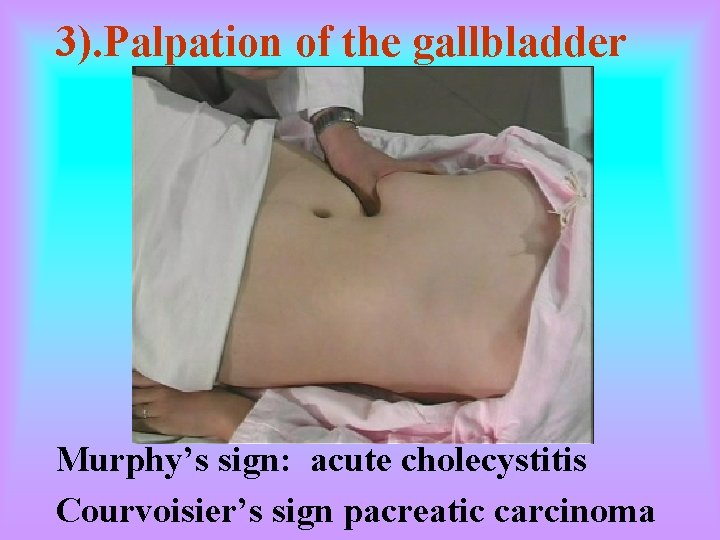 3). Palpation of the gallbladder Murphy’s sign: acute cholecystitis Courvoisier’s sign pacreatic carcinoma 