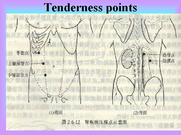 Tenderness points 