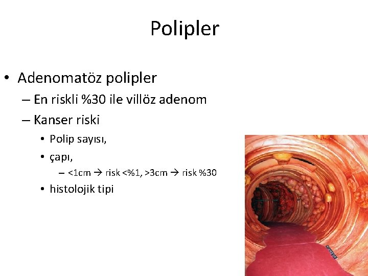 Polipler • Adenomatöz polipler – En riskli %30 ile villöz adenom – Kanser riski