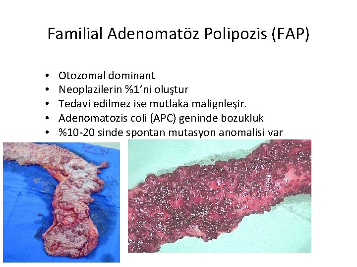 Familial Adenomatöz Polipozis (FAP) • • • Otozomal dominant Neoplazilerin %1’ni oluştur Tedavi edilmez