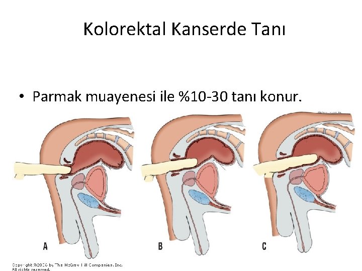 Kolorektal Kanserde Tanı • Parmak muayenesi ile %10 -30 tanı konur. 