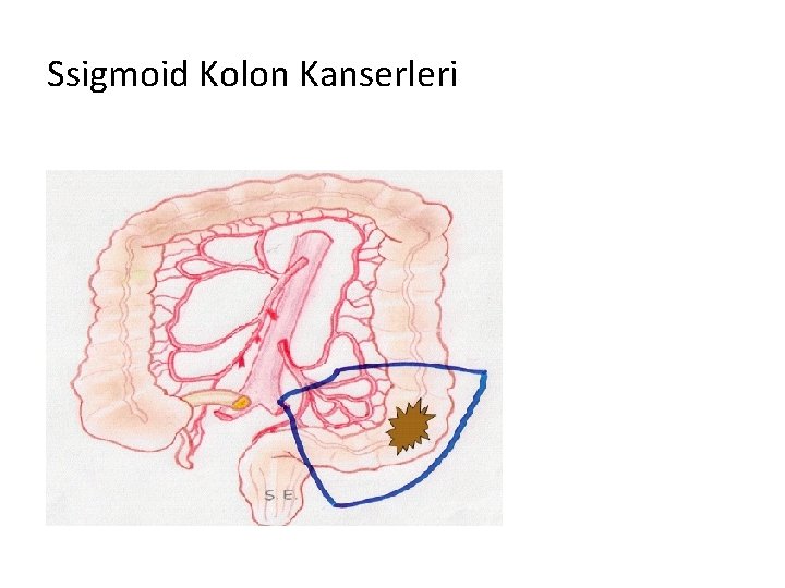 Ssigmoid Kolon Kanserleri 