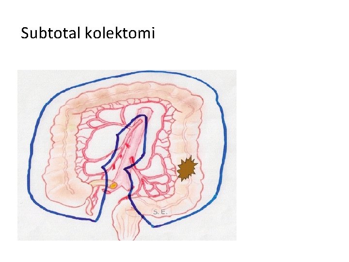 Subtotal kolektomi 