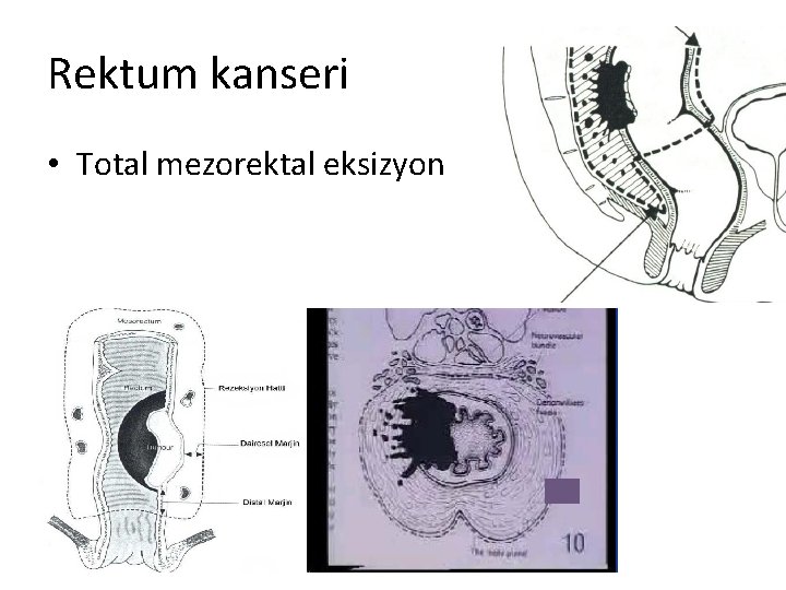 Rektum kanseri • Total mezorektal eksizyon 