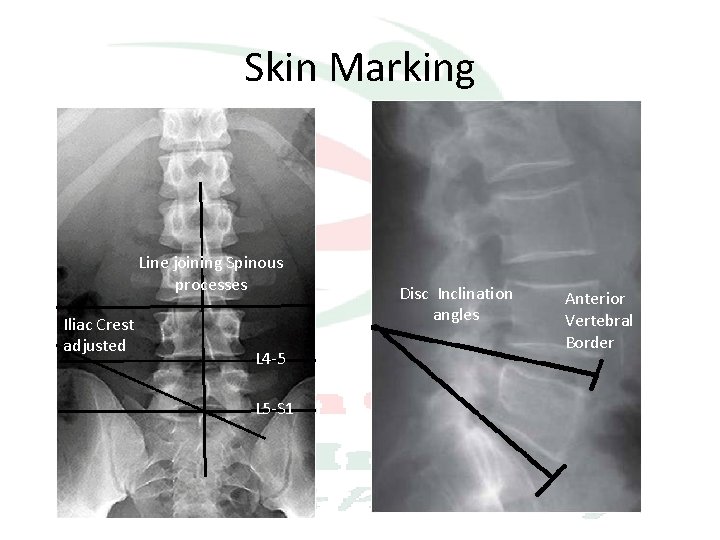 Skin Marking Line joining Spinous processes Iliac Crest adjusted L 4 -5 L 5
