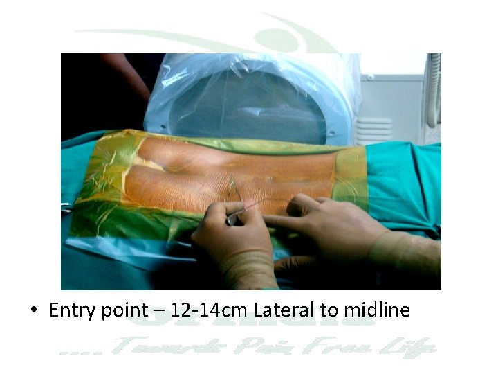  • Entry point – 12 -14 cm Lateral to midline 