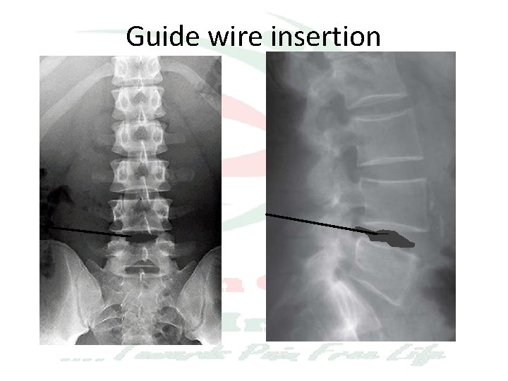Guide wire insertion 