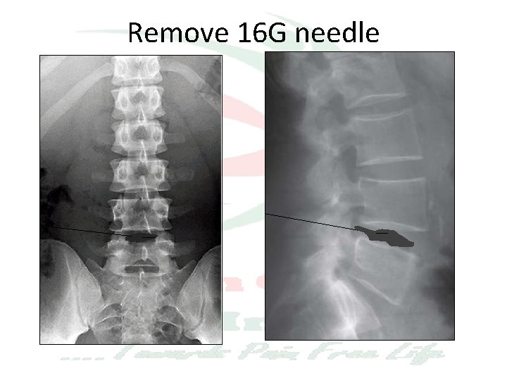 Remove 16 G needle 