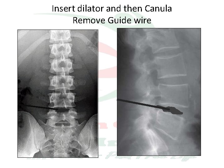 Insert dilator and then Canula Remove Guide wire 