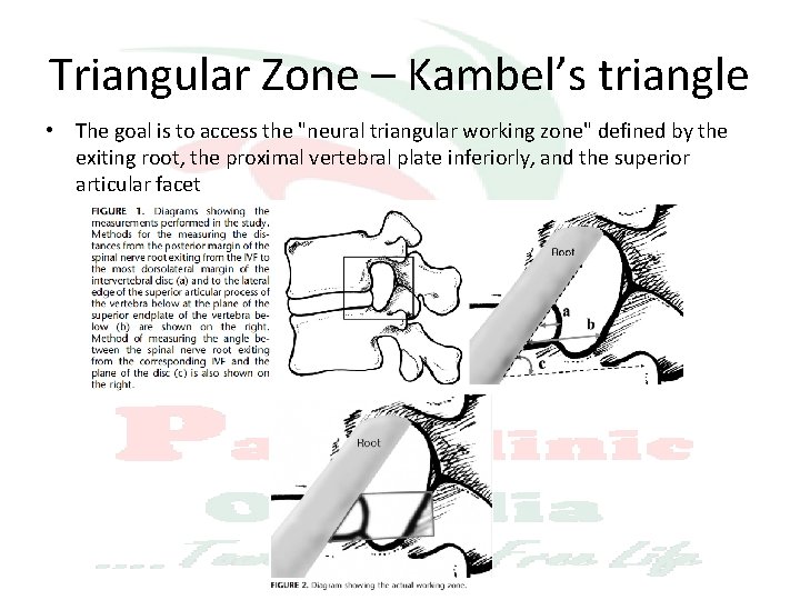 Triangular Zone – Kambel’s triangle • The goal is to access the "neural triangular