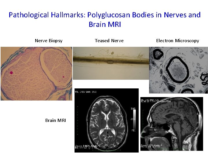 Pathological Hallmarks: Polyglucosan Bodies in Nerves and Brain MRI Nerve Biopsy Teased Nerve Electron