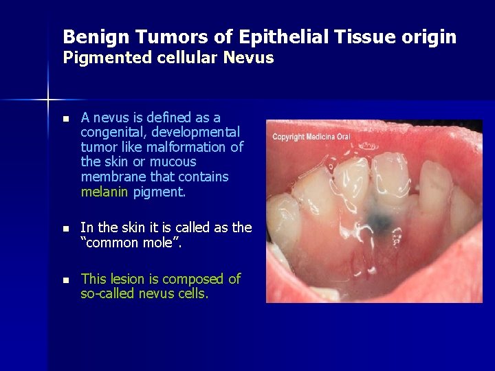 Benign Tumors of Epithelial Tissue origin Pigmented cellular Nevus n A nevus is defined