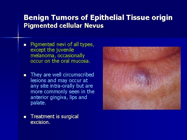 Benign Tumors of Epithelial Tissue origin Pigmented cellular Nevus n Pigmented nevi of all