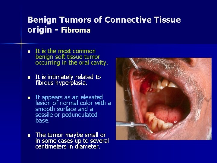 Benign Tumors of Connective Tissue origin - Fibroma n It is the most common