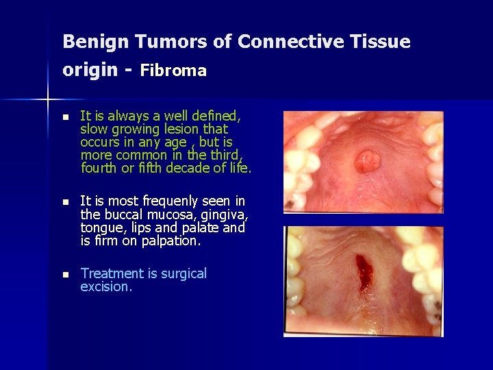 Benign Tumors of Connective Tissue origin - Fibroma n It is always a well