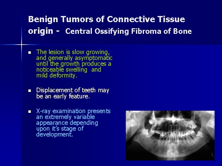 Benign Tumors of Connective Tissue origin - Central Ossifying Fibroma of Bone n The