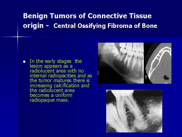 Benign Tumors of Connective Tissue origin - Central Ossifying Fibroma of Bone n In