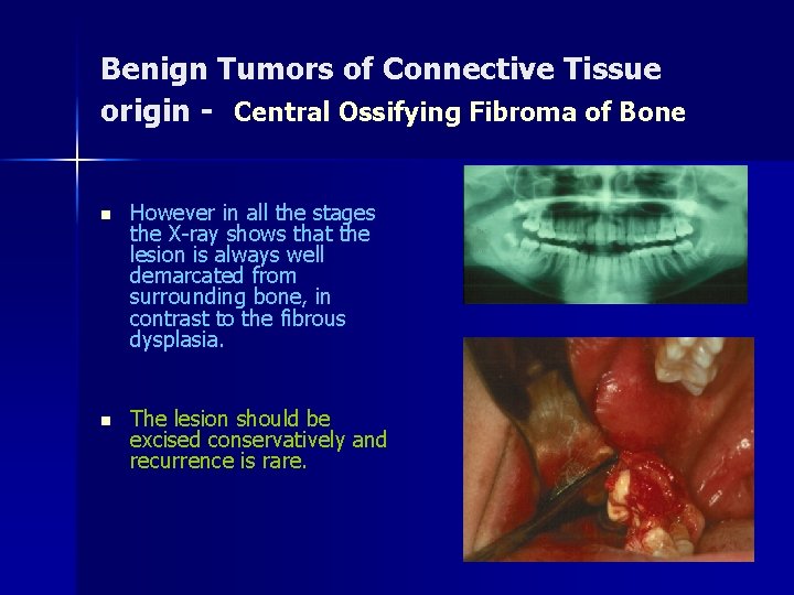 Benign Tumors of Connective Tissue origin - Central Ossifying Fibroma of Bone n However