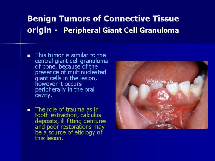 Benign Tumors of Connective Tissue origin - Peripheral Giant Cell Granuloma n This tumor