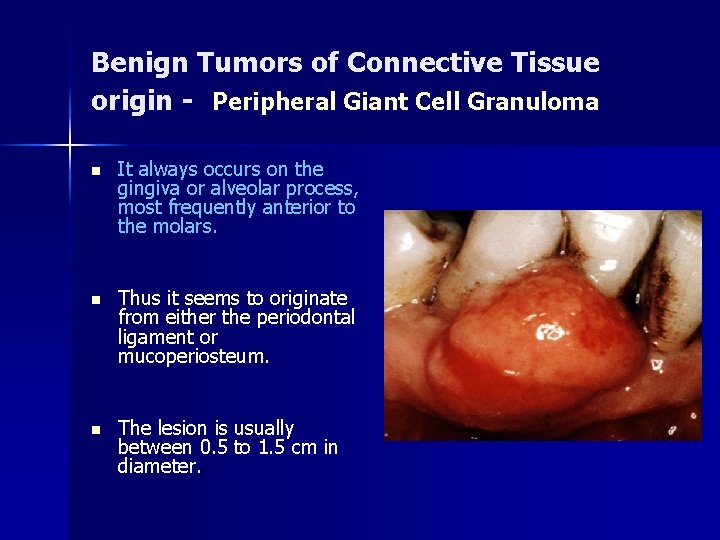 Benign Tumors of Connective Tissue origin - Peripheral Giant Cell Granuloma n It always