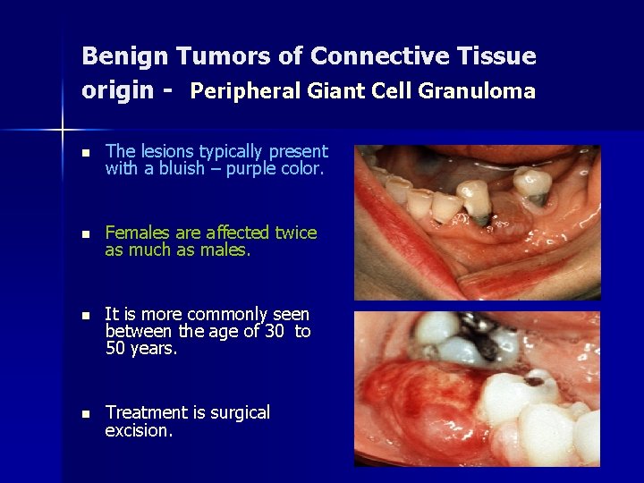 Benign Tumors of Connective Tissue origin - Peripheral Giant Cell Granuloma n The lesions