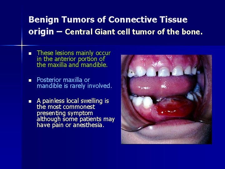 Benign Tumors of Connective Tissue origin – Central Giant cell tumor of the bone.